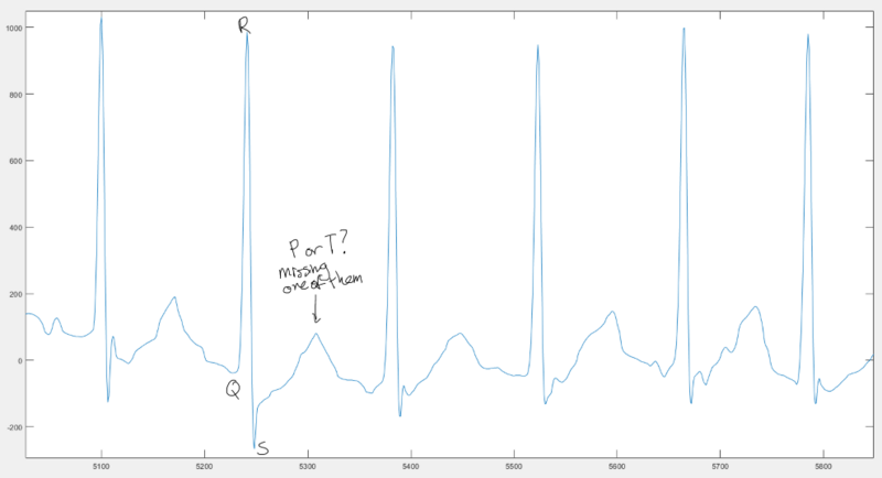 File:Other ECG Annotated Waveform.png